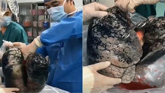 30 ஆண்டுகளாக அந்த பழக்கம்..! இறந்தபிறகு வயிற்றை கிழித்து பார்த்த மருத்துவர்கள் ஓட்டம்!!