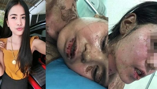 பல் வலிக்காக மருந்து சாப்பிட்ட இளம் பெண்..! மருந்து சாப்பிட்ட உடனே தோல் உடலில் இருந்து பிரிய தொடங்கியது..! பகீர் சம்பவம்..!