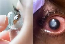 லென்ஸ் அணிந்துகொண்டு தூங்கினால் இவ்வளவு பெரிய ஆபத்தா? ஜாக்கிரதை… பார்வை கூட பறிபோகலாம்!