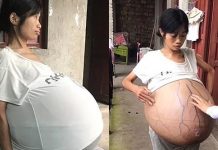 பலூன் போல் நாளுக்குநாள் வீங்கிக்கொண்டே செல்லும் பெண்ணின் வயிறு: காரணம் தெரியாமல் திகைக்கும் மருத்துவர்கள்!!