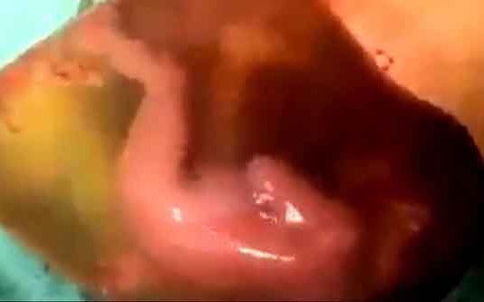 பனிக்குடத்துடன் வெளிவந்த குழந்தை : மருத்துவ உலகின் அதிசயம்! படைத்த கடவுளையும் வியக்க வைத்த அரிய காட்சி!!