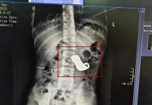 தொலைக்காட்சி பார்த்ததால் வந்த வினை : 4 மணிநேர அவசர அறுவை சிகிச்சையின் பின் மீட்கப்பட்ட சிறுவன்!!