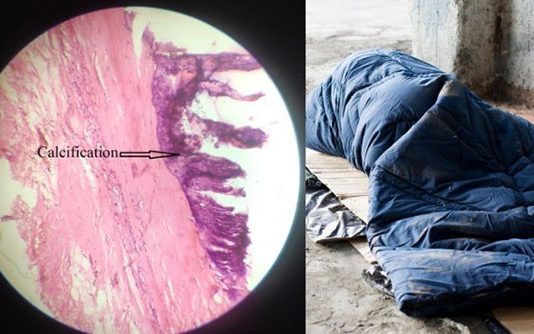 வீதியில் இ ற ந்த நபர் : கல்லாக உறைந்து போன இருதயம் : உடற்கூராய்வில் மருத்துவர்களை அ.தி.ரவைத்த சம்பவம்!!