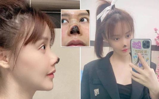 மூக்கை அழகுப்படுத்த நினைத்து விபரீதத்தில் சிக்கிய சைனீஸ் நடிகை; ஆறுதல் கூறும் ரசிகர்கள்!!