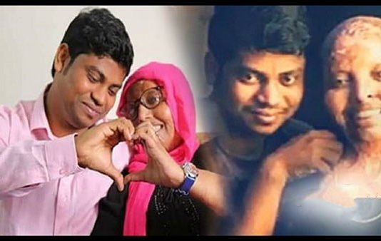 காதலை நிராகரித்ததால் முகத்தை இழந்த பெண்ணை மீண்டும் தேடி வந்த காதல் : நெகிழவைக்கும் சம்பவத்தின் பின்னணி !!