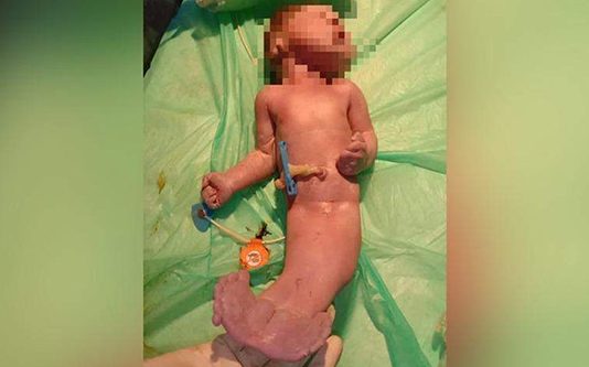 மீன் போன்று பிறந்த கு ழ ந்தை! 2 மணிநேரத்தில் உ.யி.ரிழந்த ப.ரி.தாபம்!!