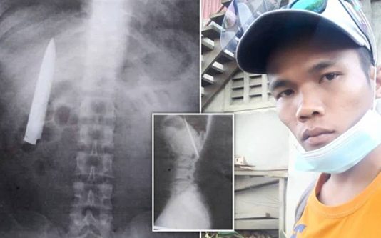 சாதரண மருத்துவ பரிசோதனைக்கு சென்ற இளைஞர்! X-ray-வில் காத்திருந்த அதிர்ச்சி!!