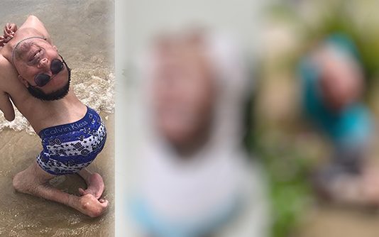 முதுகு பக்கம் தலைகீழ் தலையுடன் பிறந்த நபர்: 44 ஆண்டுகளுக்கு பிறகு இப்போது எப்படி இருக்கிறார் என்று பாருங்கள்!