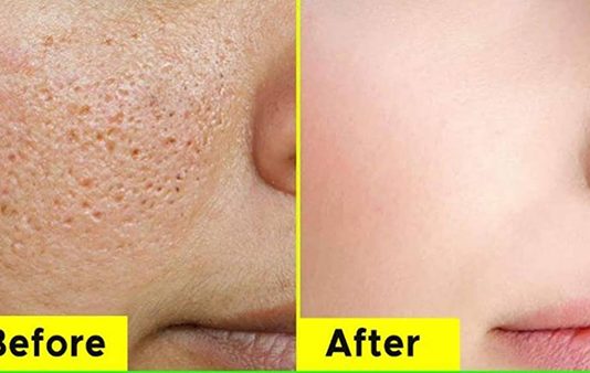 முகத்தில் ஏற்படும் சரும துளைகளை நீக்க வேண்டுமா? இந்த பொருட்கள் மட்டும் பயன்படுத்தி பாருங்க!!