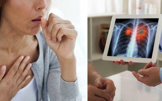 இருமல், சளி என சென்ற இ ளம் பெ ண்ணின் நுரையீரலில் சி க்கிருந்த அந்த பொருள்! அ திர்ந்துபோன ம ருத்துவர்கள்!