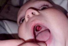 10 மாத குழந்தையின் தொண்டையில் இருந்த பயங்கரமான ஓட்டை! பதறியடித்து மருத்துவமனைக்கு சென்ற தாய்!!