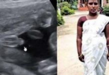 வயிற்றில் குழந்தை என 7 மாதமாக சிகிச்சையளித்த மருத்துவர்.. திடீரென ஏற்பட்ட வலி! ஸ்கேனில் தெரியவந்த அ.திர்ச்சி தகவல்!!