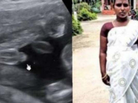 வயிற்றில் குழந்தை என 7 மாதமாக சிகிச்சையளித்த மருத்துவர்.. திடீரென ஏற்பட்ட வலி! ஸ்கேனில் தெரியவந்த அ.திர்ச்சி தகவல்!!
