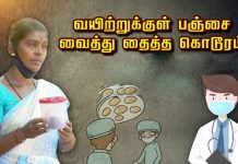 வயிற்றுக்குள் பஞ்சை வைத்து தைத்த கொடூரம் : அம்பலமான அதிர்ச்சி தகவல்!!