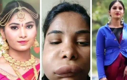 மயக்க ஊசிக்கு பதில் ஆசிட்டை செலுத்திய மருத்துவர் : பிரபல நடிகையின் கோர தோற்றத்துக்கு இதுதான் காரணமா?