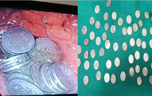 வயிற்று வலி… இளைஞனுக்கு அறுவை சிகிச்சை செய்த போது வைத்தியர்களுக்கு காத்திருந்த அதிர்ச்சி!!