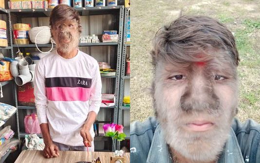 உடல் முழுவதும் ரோமங்கள்… மக்கள் கல்லால் அடித்தும் தன்னம்பிக்கையை இழக்காத இளைஞர் : சுவாரஸ்ய தகவல்!!