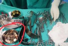 முதியவரின் வயிற்றில் 187 நாணயங்கள்… ஒன்றரை கிலோ எடை இருந்ததால் மருத்துவர்கள் அதிர்ச்சி : நடந்த விபரீதம்!!