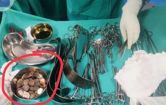 முதியவரின் வயிற்றில் 187 நாணயங்கள்… ஒன்றரை கிலோ எடை இருந்ததால் மருத்துவர்கள் அதிர்ச்சி : நடந்த விபரீதம்!!