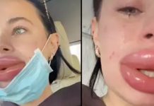 சத்திர சிகிச்சை மூலம் உதடை அழகாக்க முயற்சித்த பெண்ணுக்கு நேர்ந்த கதி!!