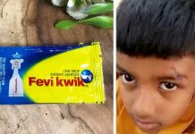 சிறுவனுக்கு புருவத்தில் ஏற்பட்ட காயம்.. தையலுக்கு பதில் பெவிகுயிக் போட்டு ஒட்டிய மருத்துவமனை!!