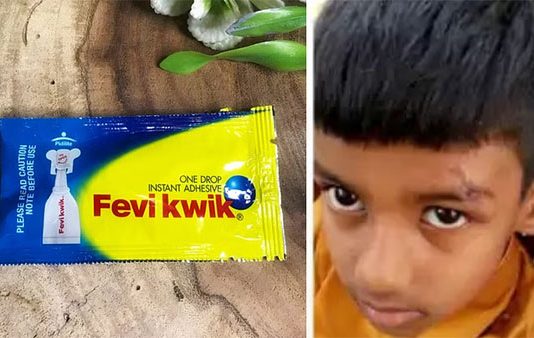 சிறுவனுக்கு புருவத்தில் ஏற்பட்ட காயம்.. தையலுக்கு பதில் பெவிகுயிக் போட்டு ஒட்டிய மருத்துவமனை!!