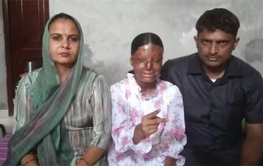 3 வயதில் ஆசிட் வீச்சால் சிதைந்த முகம்… 15 வயதில் CBSE 10ம் வகுப்பு தேர்வில் முதலிடம் : தன்னம்பிக்கை சிறுமி!!