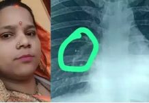 17 ஆண்டுகளாக பெண்ணின் நுரையீரலில் சிக்கிய மூக்குத்தி!!