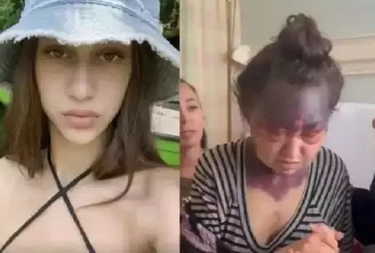 தடுப்பூசி எதிர்வினையால் உருக்குலைந்த இளம்பெண்!!